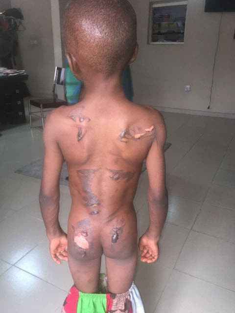 Calabar Woman Burns Her 8-Year-Old Nephew With Hot Iron For Eating Her N50 Groundnut [Photo] 6