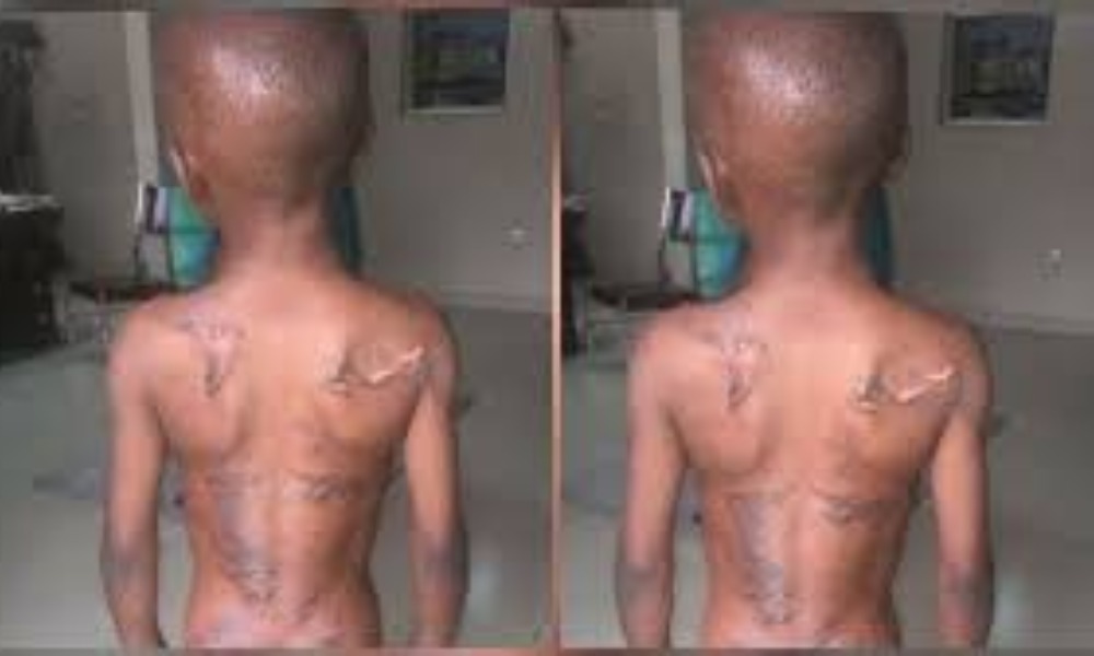 Calabar Woman Burns Her 8-Year-Old Nephew With Hot Iron For Eating Her N50 Groundnut [Photo] 5