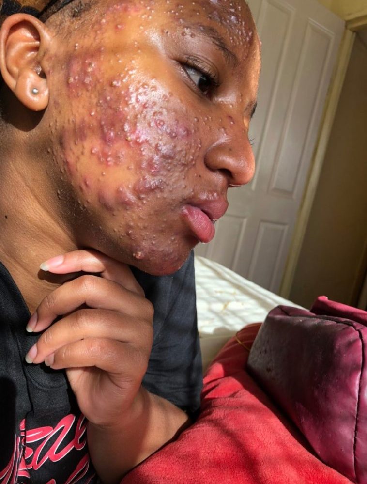 758px x 999px - Lady Shows Off Incredible Facial Transformation After Battling Acne For  Years (Graphic Photos)