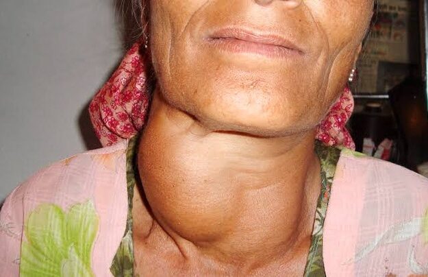 6 Causes of goiter (Thyroid Swelling)