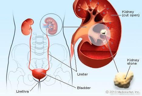 Everyday drinks that can cause kidney stones