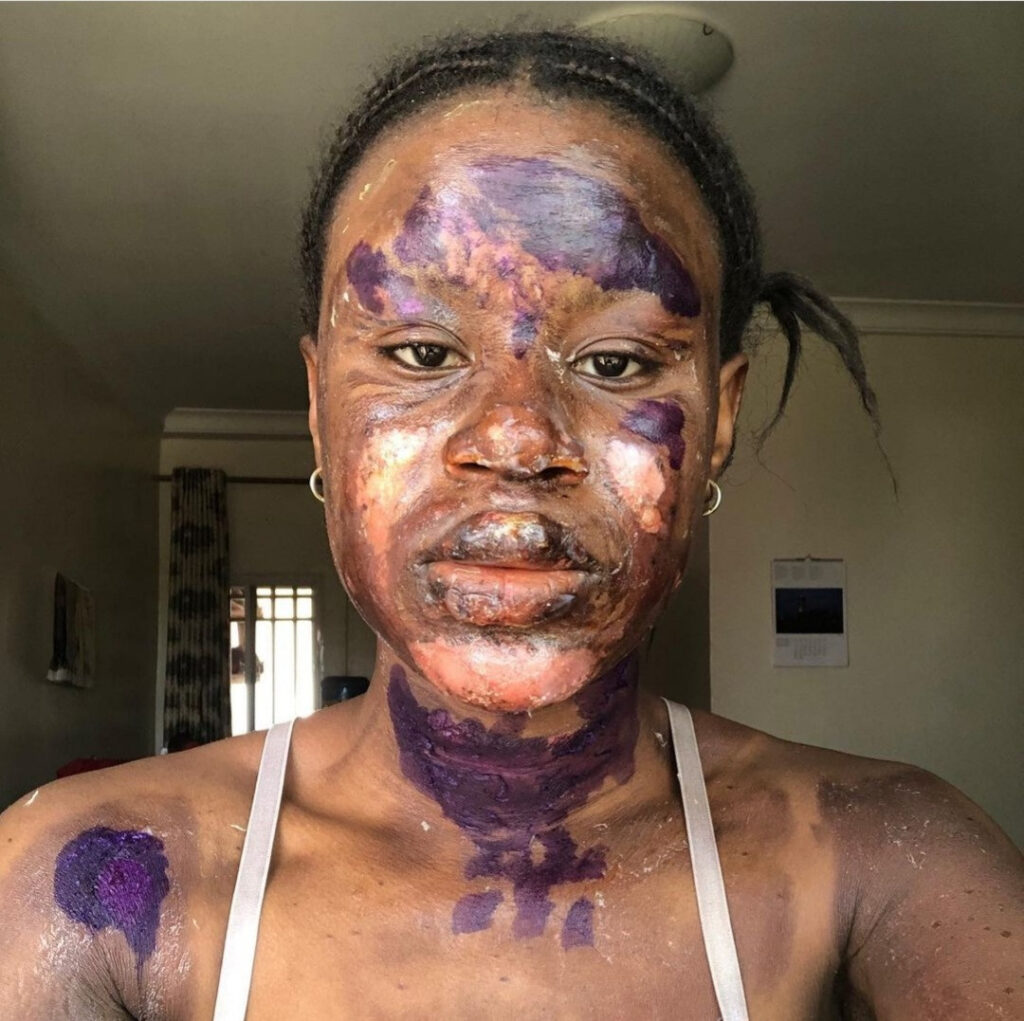 Burn Survivor Shows Off Her Amazing Transformation As Skin Heals Without Blemish