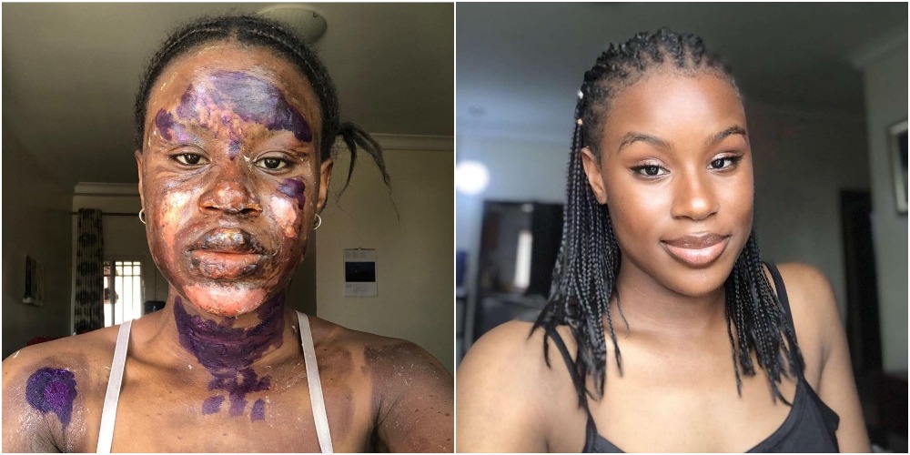 Burn Survivor Shows Off Her Amazing Transformation As Skin Heals Without Blemish