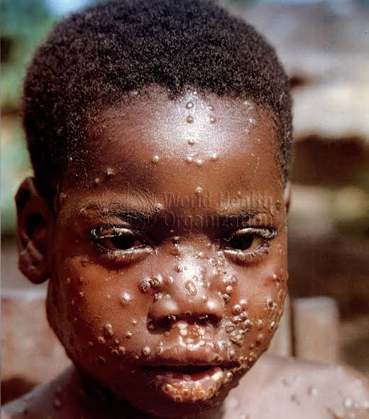 Anambra Records First Monkeypox Case, Warns Residents to Stay Safe