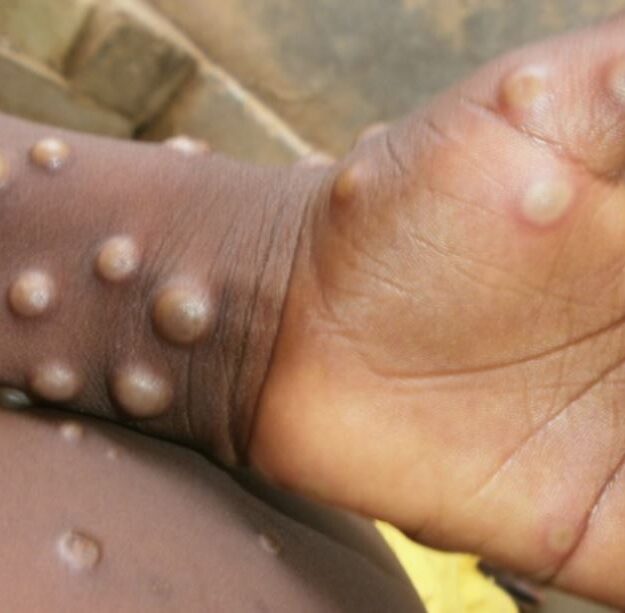 Nasarawa Records Six Cases Of Monkeypox