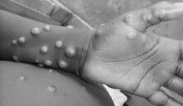 Delhi reports fourth monkeypox case as 31-yr-old Nigerian woman tests positive; India’s tally stands at nine