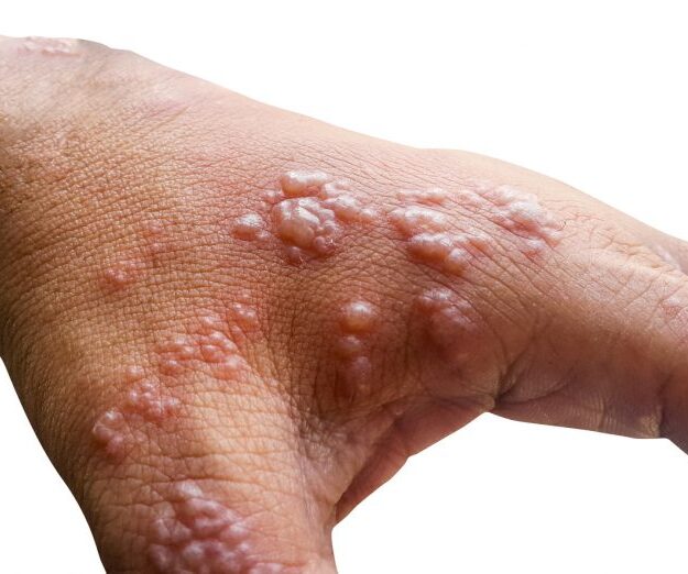 How to take care of monkeypox lesions: Experts recommend doing this