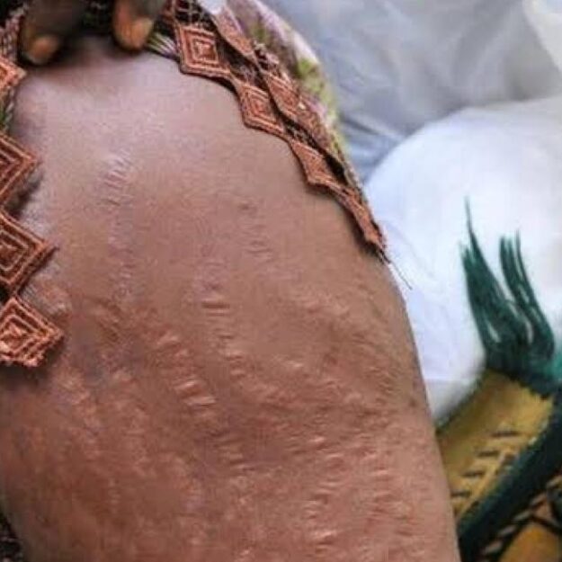 77% Of Nigerian Women Use Bleaching Creams, Risk Cancer, Damage To Vital Organs – NAFDAC Cautions