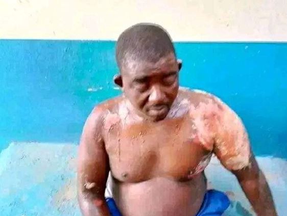 Update: Newly Wedded Wife Bathed Her Husband With Hot Water For Stopping Her From Calling Other Men